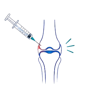 Hyaluronic acid knee injection illustration